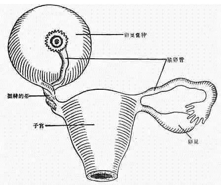试管取卵后卵巢扭转，风险、预防与处理